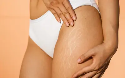 Une femme touche sa cuisse, montrant des vergetures. Des conseils sur comment perdre de la cellulite sont recherchés.